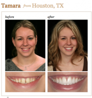 Smile Makeover