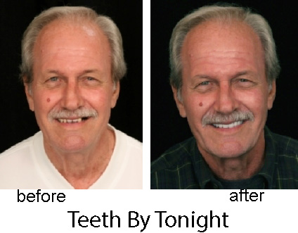 Dental Implants