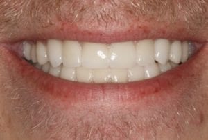 após a imagem de um homem que passou por um procedimento de implante dentário em Sugar Land TX