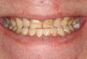  o imagine anterioară a unui bărbat care a suferit o procedură de implant dentar în Sugar Land TX