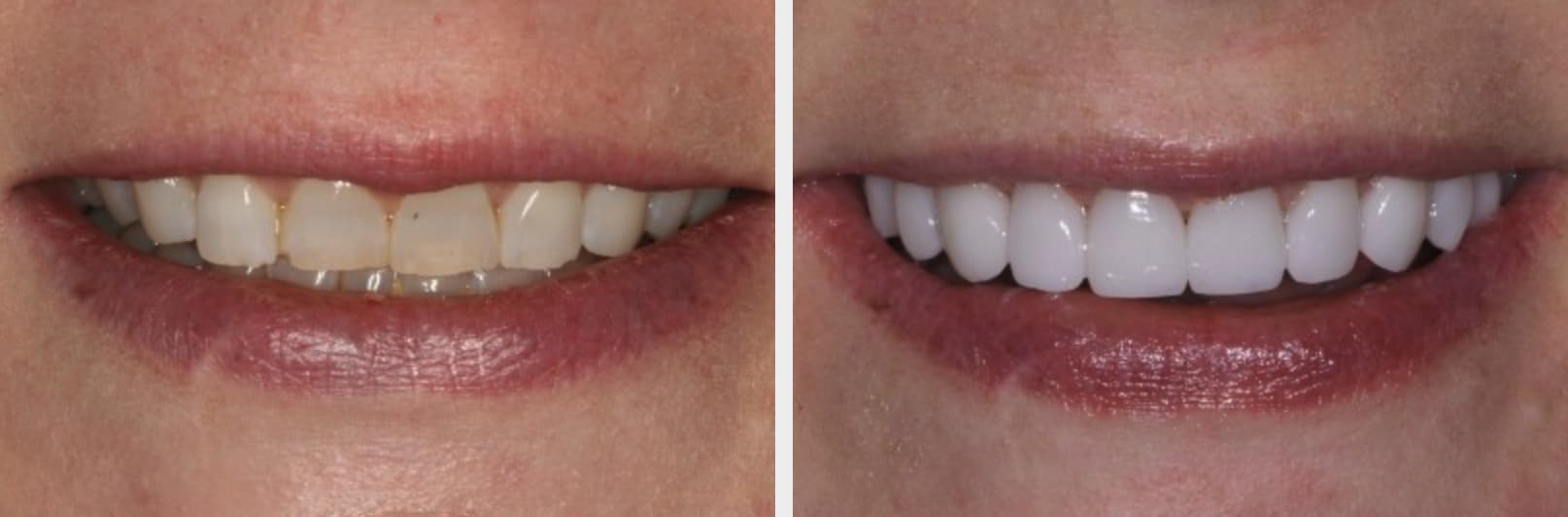 before and after close up of woman's teeth after dental implants