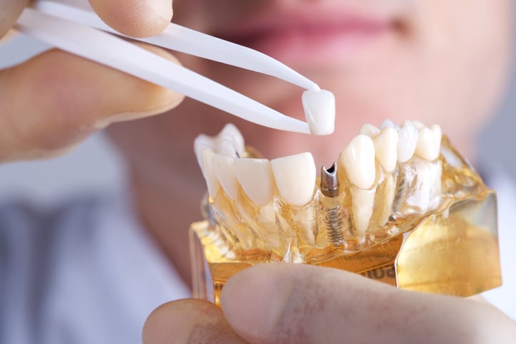 un dentist care pune un implant dentar pe un model de maxilar uman