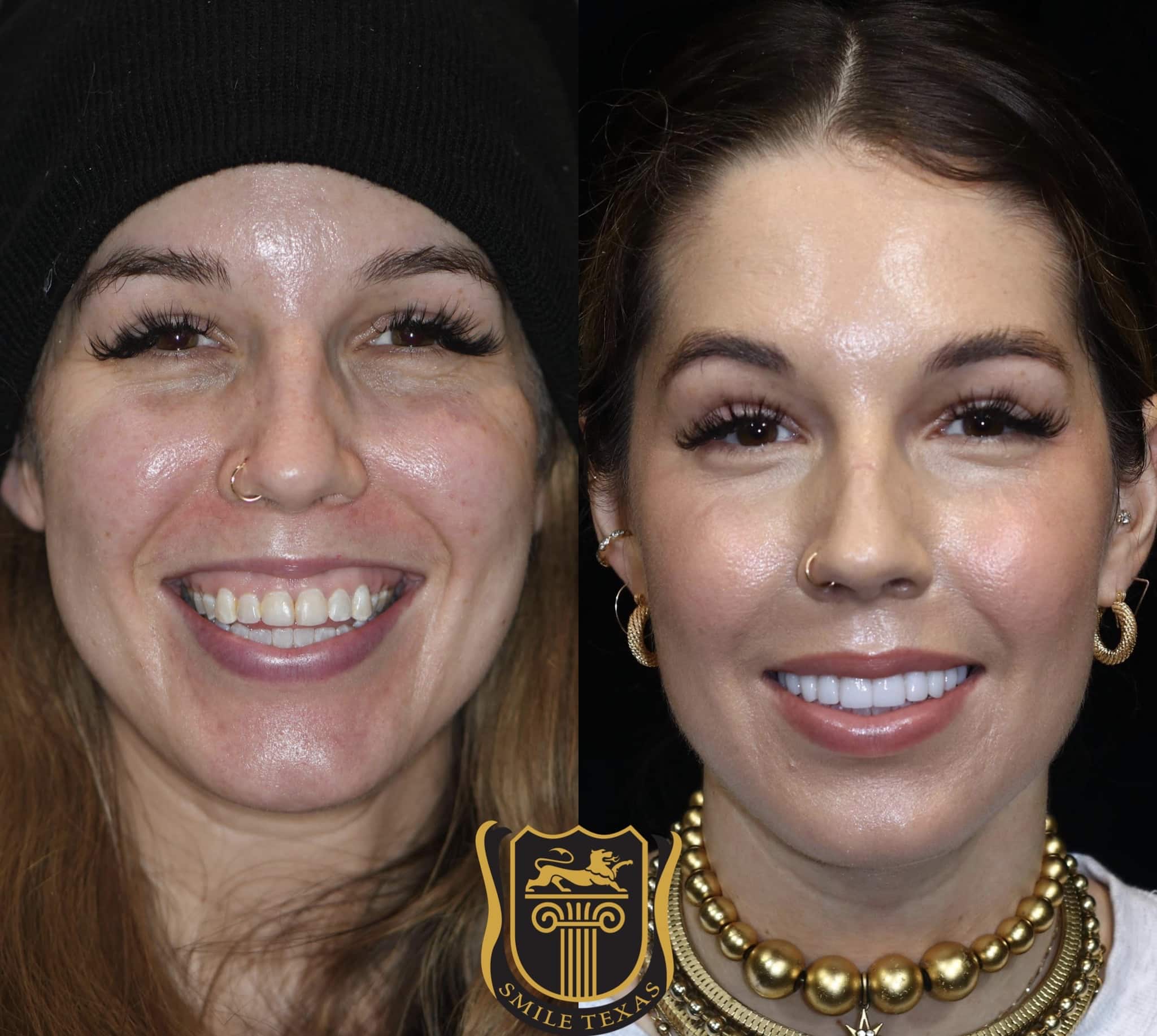 woman before and after GumTuk treatment for a gummy smile