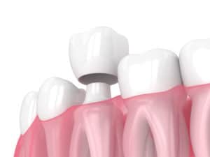 3d-render animation of porcelain crown being placed on tooth