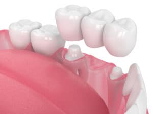 3d render of jaw with porcelain bridge over white background