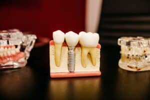 dental implants
