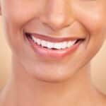 A close-up shot of a woman's smile after Teeth by Tonight® dental implants