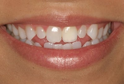 Porcelain Veneers Houston | Veneers TX | Cosmetic Dentistry Sugar Land